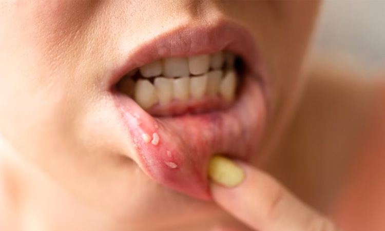  Ayurvedic treatment for mouth ulcers in Dubai