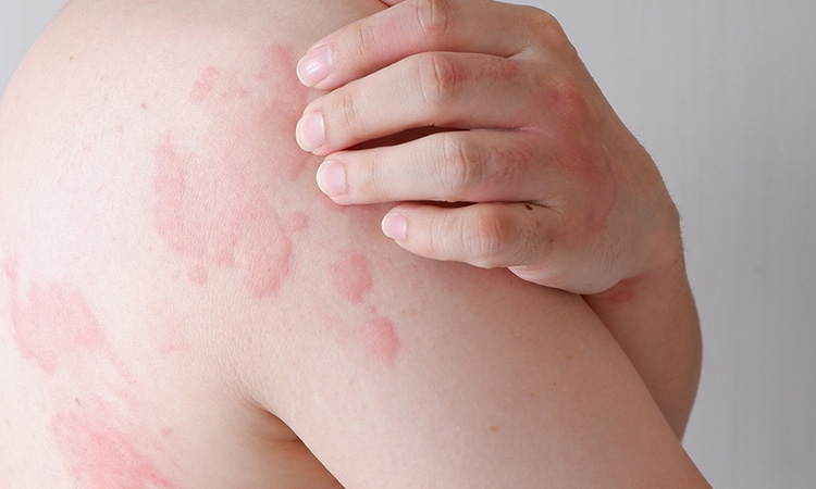 Urticaria or Hives