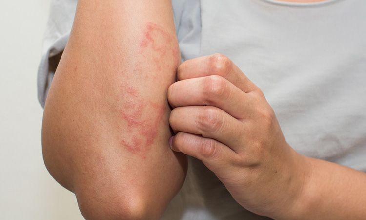 Atopic Eczema and Contact Allergic Dermatitis