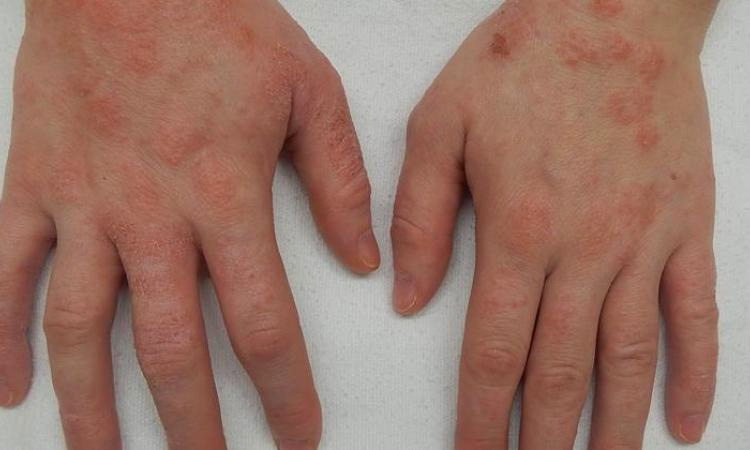 Seborrhoeic Dermatitis