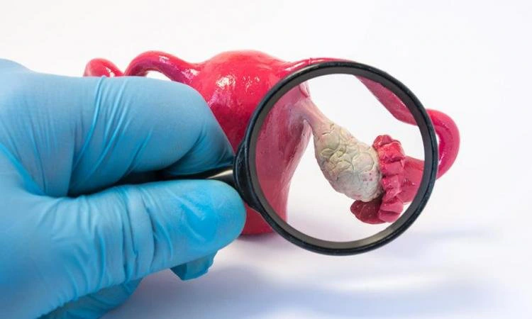 Ayurveda treatment for PCOD