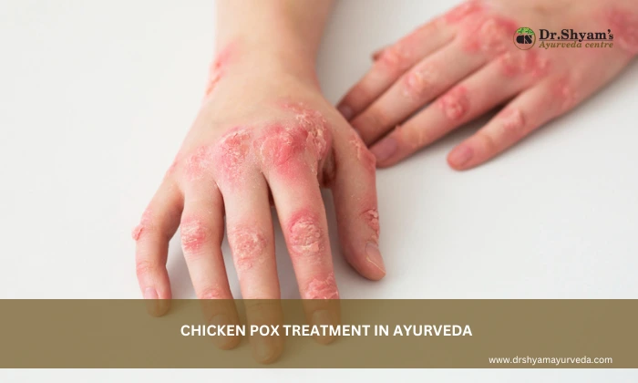 Chicken Pox Treatment in Ayurveda